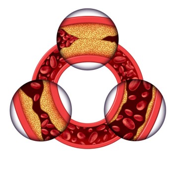 Coronary Artery Bypass by OrangeCountySurgeons